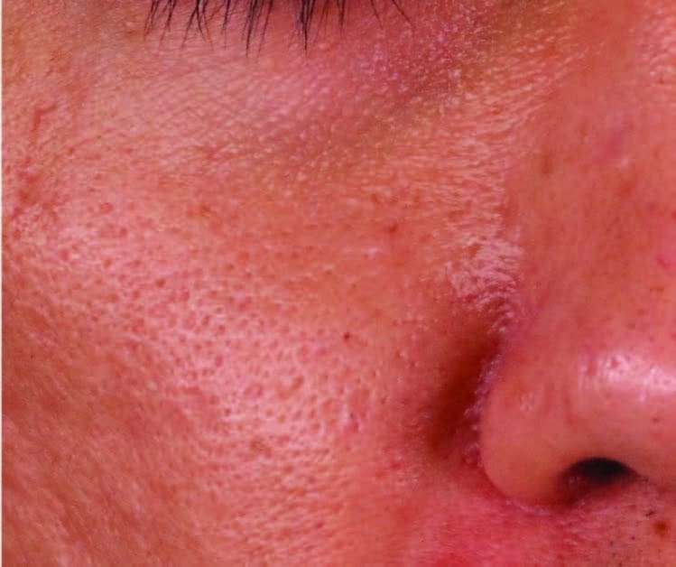 Introduction to Enlarged Pores, image are from Crown Clinic, Mona Alqam, MD.