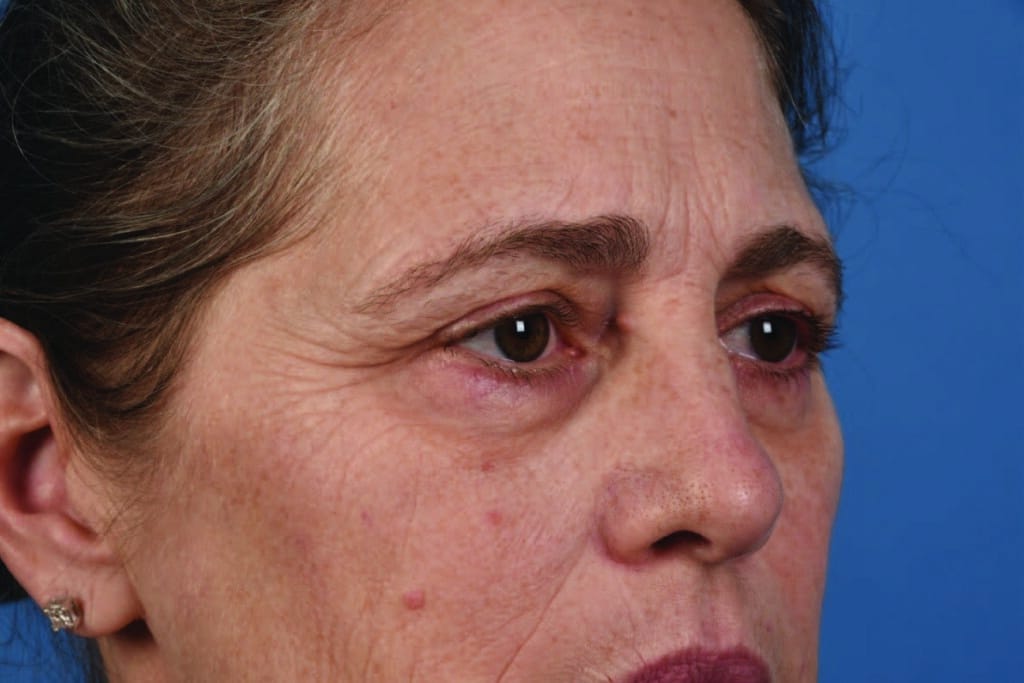 Introduction to Fine Lines and Wrinkles, Considered a part of the aging process of the skin.