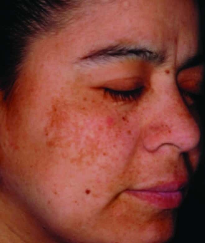 Introduction to Mottled Hyperpigmented Lesions/Patches.