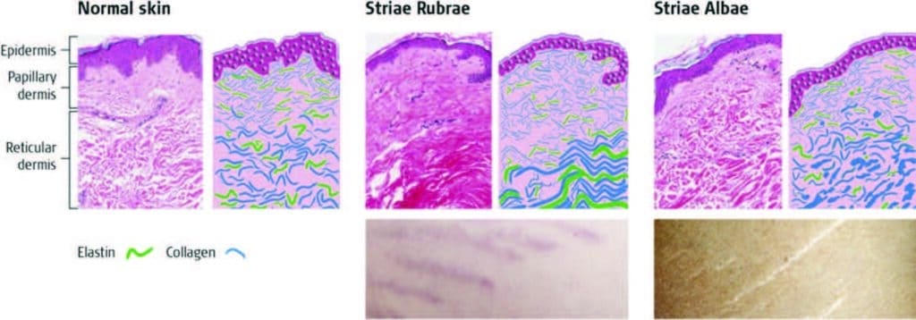 Introduction to Stretch Marks, can be caused by an overextension of the skin.